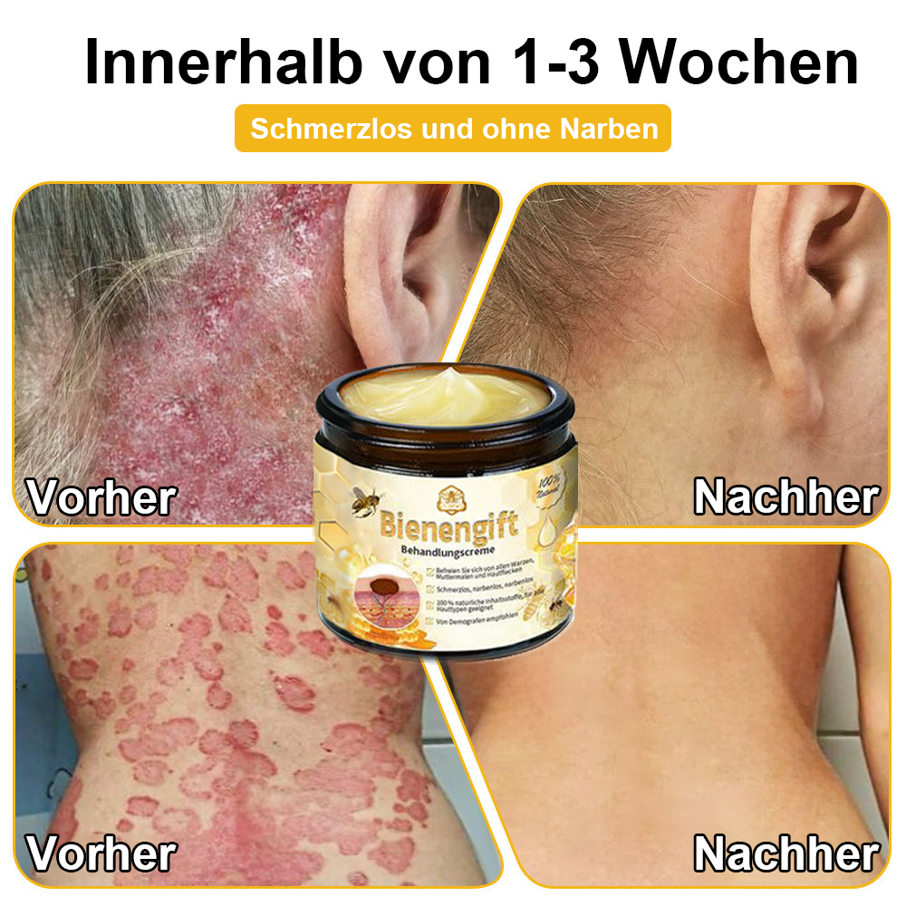 [Zusätzliche 30 % Rabatt] TLOPA® Fortgeschrittene Bienengift Behandlungscreme  (🔥Letzter Tag Aktion 80% Rabatt)