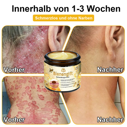 [Zusätzliche 30 % Rabatt] TLOPA® Fortgeschrittene Bienengift Behandlungscreme  (🔥Letzter Tag Aktion 80% Rabatt)