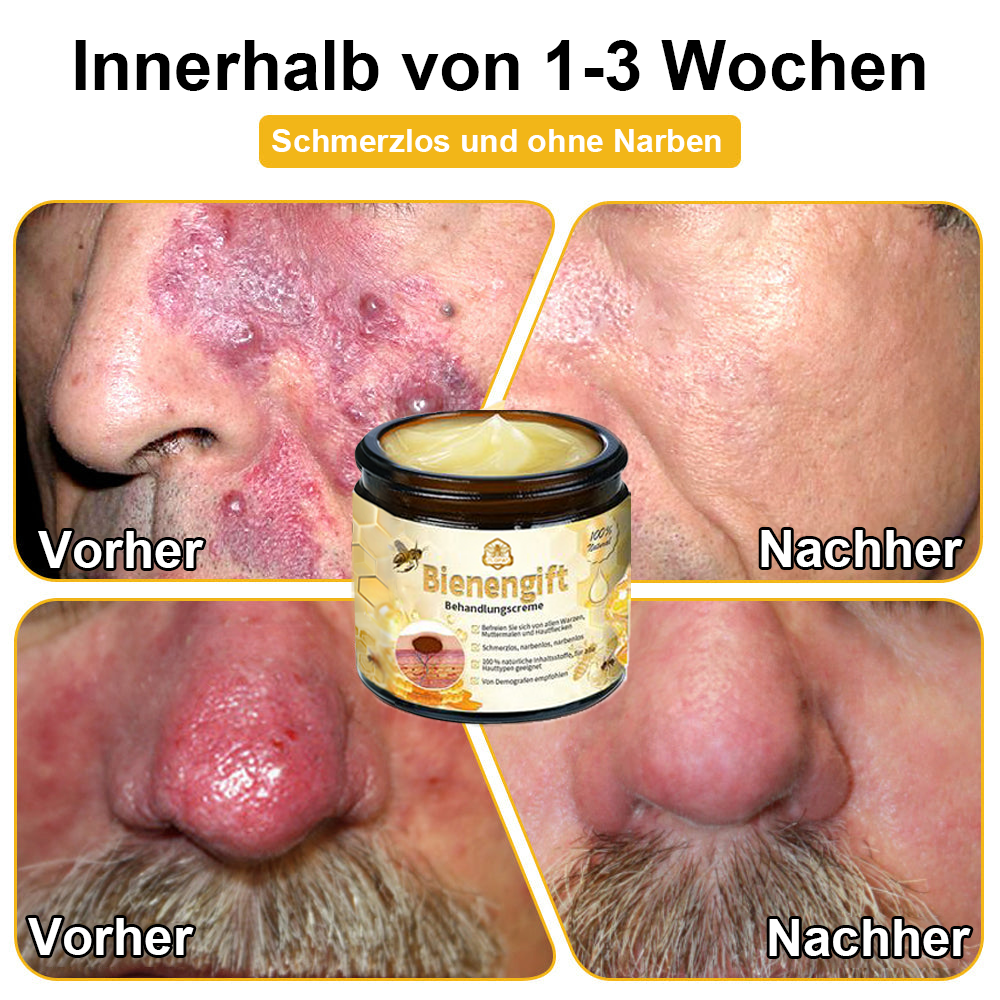 [Zusätzliche 30 % Rabatt] TLOPA® Fortgeschrittene Bienengift Behandlungscreme  (🔥Letzter Tag Aktion 80% Rabatt)